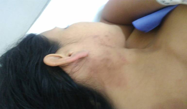 Joven mujer fue atacada con ácido en el Valle del Cauca