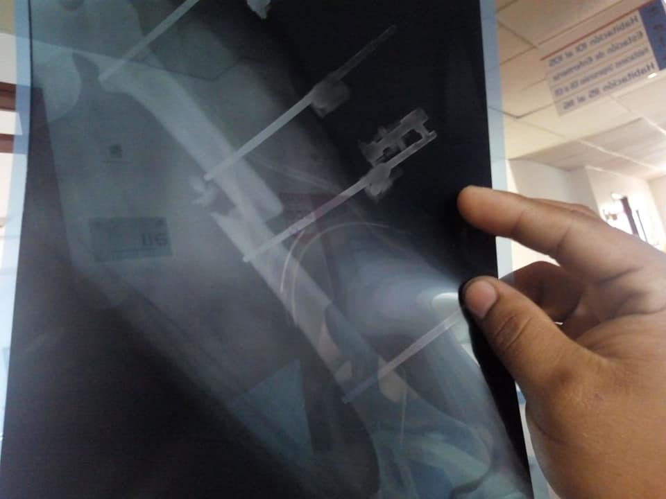 Joven accidentado en Cartago teme perder su pierna por no autorización de la EPS